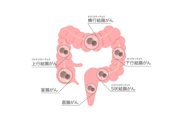 大腸がんとは